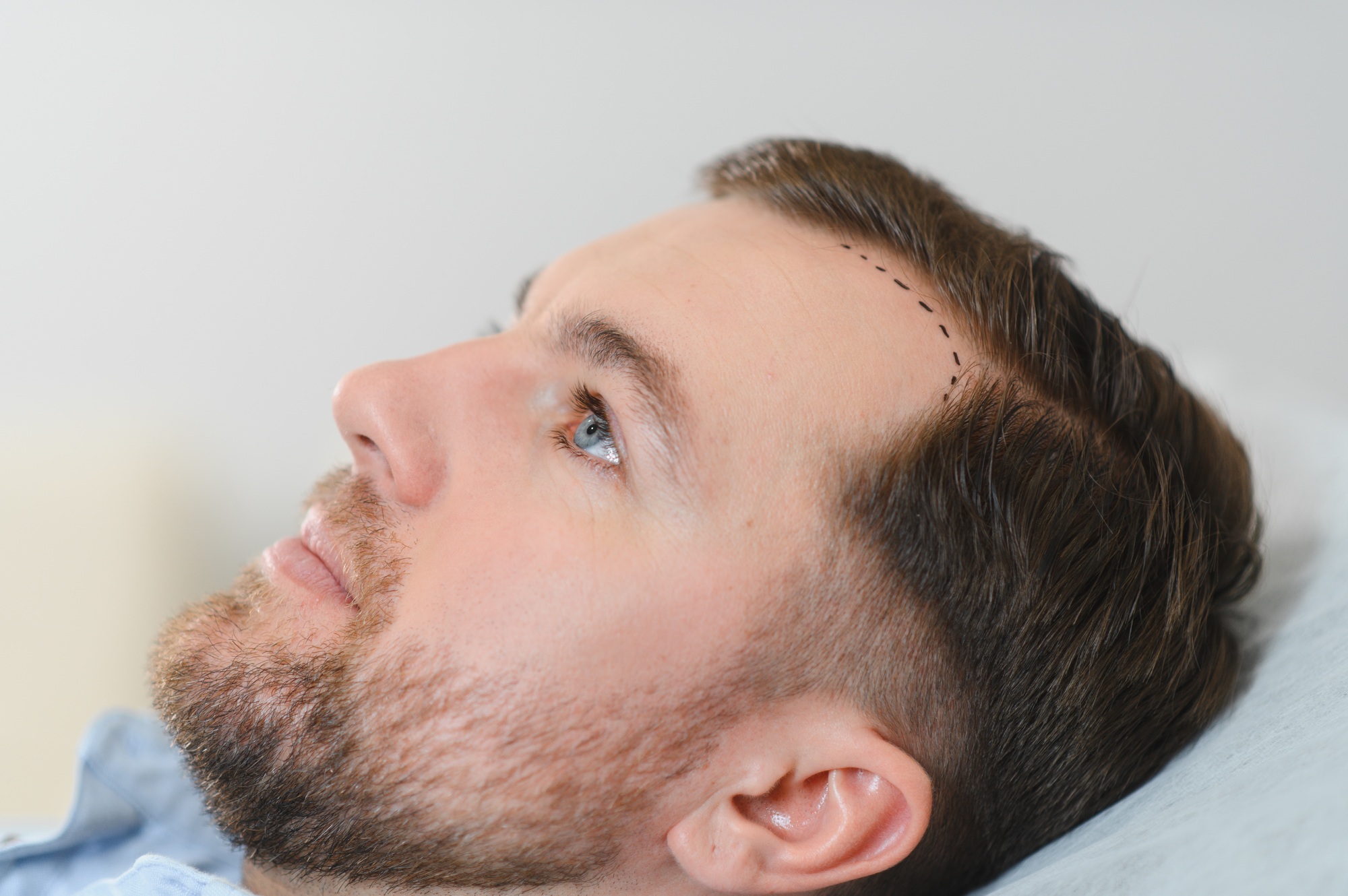 doctor trichologist outlines the area of baldness on the client s head with a marker